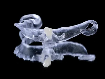 Cast Partial Denture