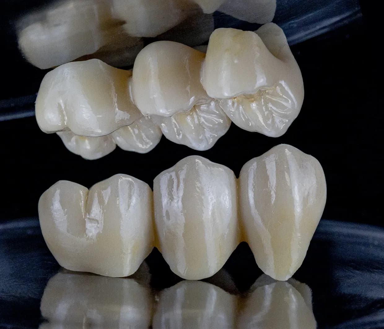 Ceramic Anterior Bridge
