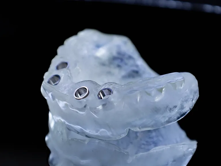 3D-Printed Restoration