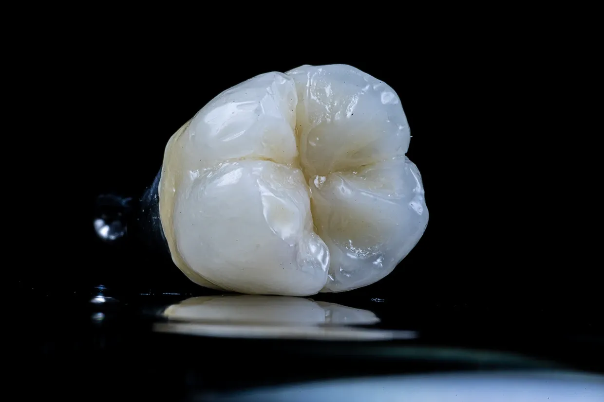 Ceramic Inlay & Onlay