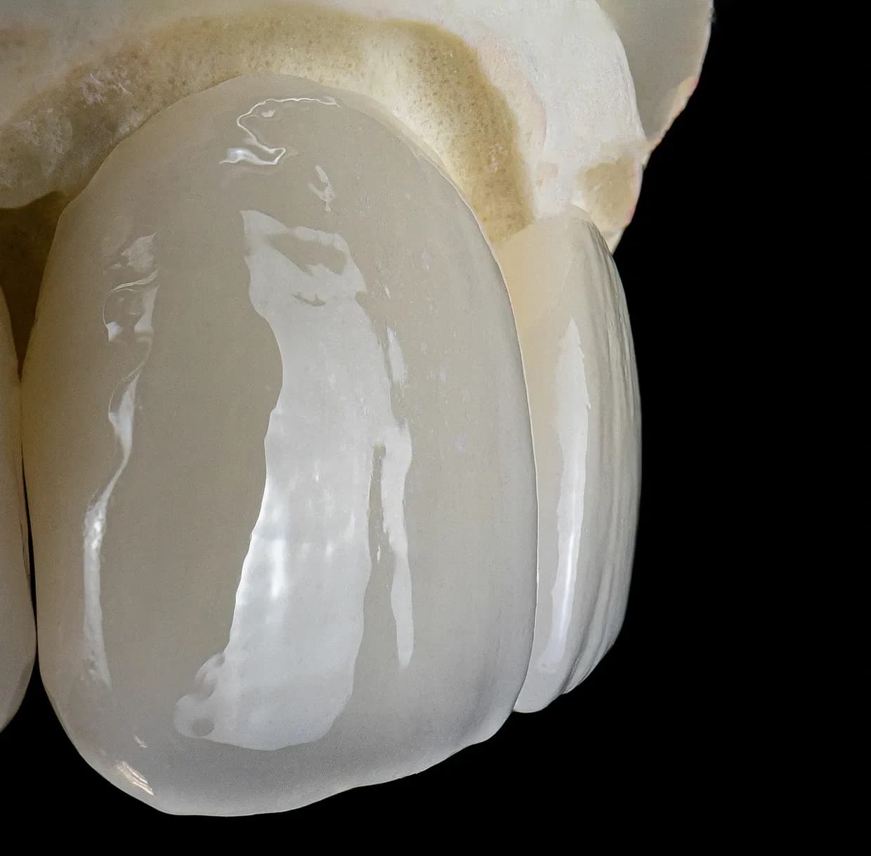 Layered Zirconia Crown