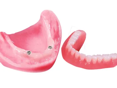 Locator Attachment Denture