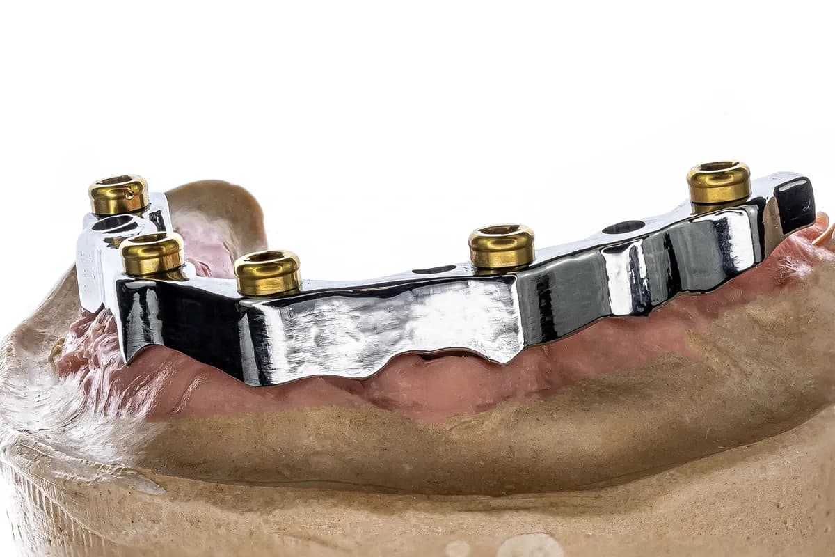 Locator Bar Overdenture