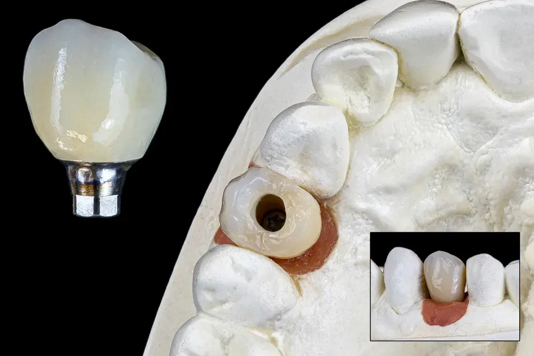 Implant Packages