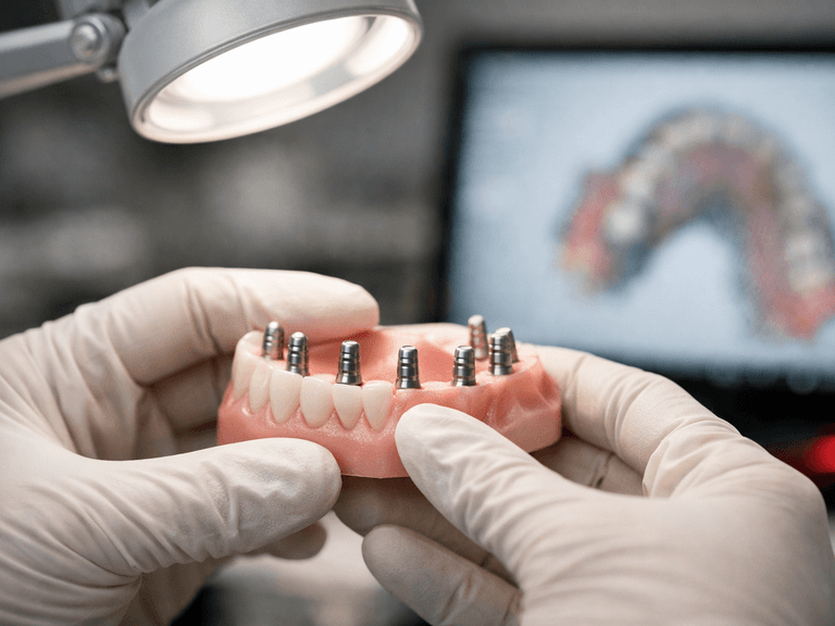 Hero image for the article "How to Scan Accurately for Full-Arch Restorations: A Lab's Field Guide"