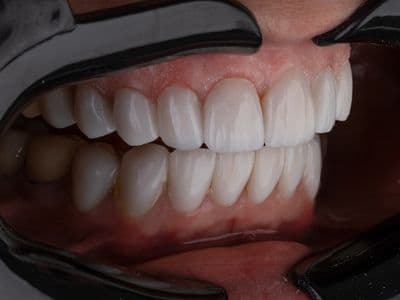 Implant-Supported Overdenture